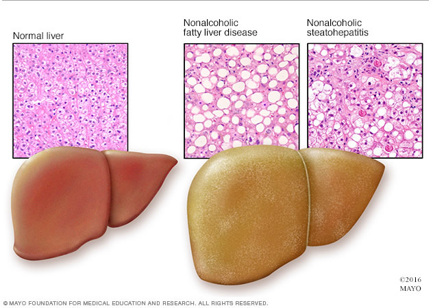 Diagnosis of Fatty Liver Disease
