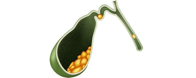 Gallstones
